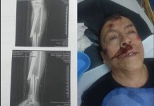 Chicoloapan: atropellan a adulto mayor; piden a Fiscalía no liberar a motociclista